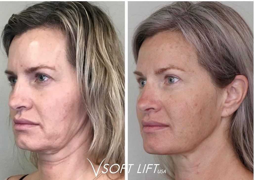 Before and after comparison of a woman's facial cosmetic procedure.