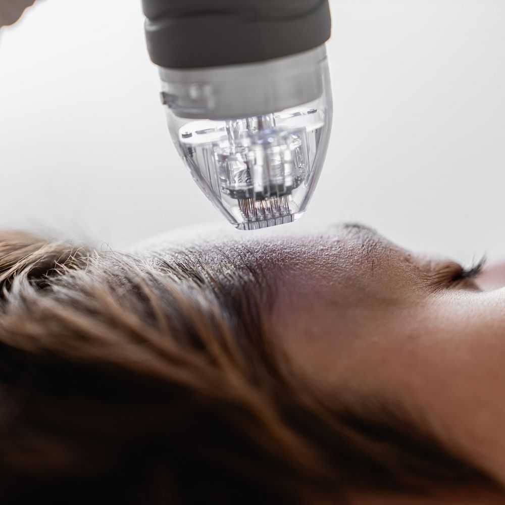 Microscopic hair examination equipment analyzing a person's scalp.